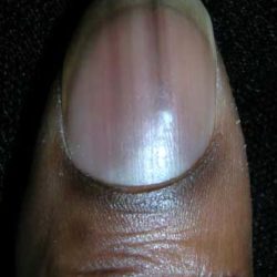 Patient education Nail and Skin Black Toenail