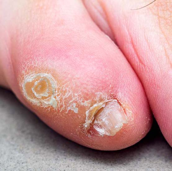 Patient education Nail and Skin Corn on Toe