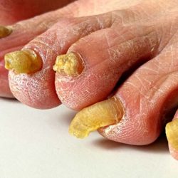 Patient education Nail and Skin Fungal toenail
