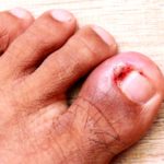 Ingrown Toenail Removal