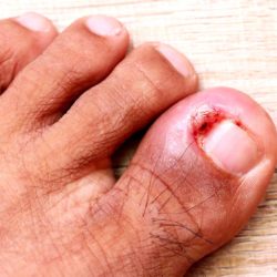 Patient education Nail and Skin Ingrown toenail with proud flesh
