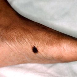 Patient education Nail and Skin Melanoma on Dark Skin