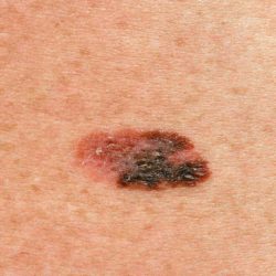 Patient education Nail and Skin Melanoma on White Skin