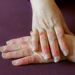 Raynauds Syndrome on the hand