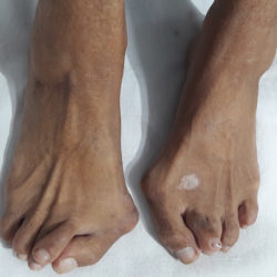 Rheumatoid Arthritis Black skin
