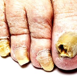 Patient education Nail and Skin Thick Toenails