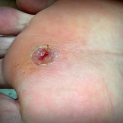 Ulcer-Foot