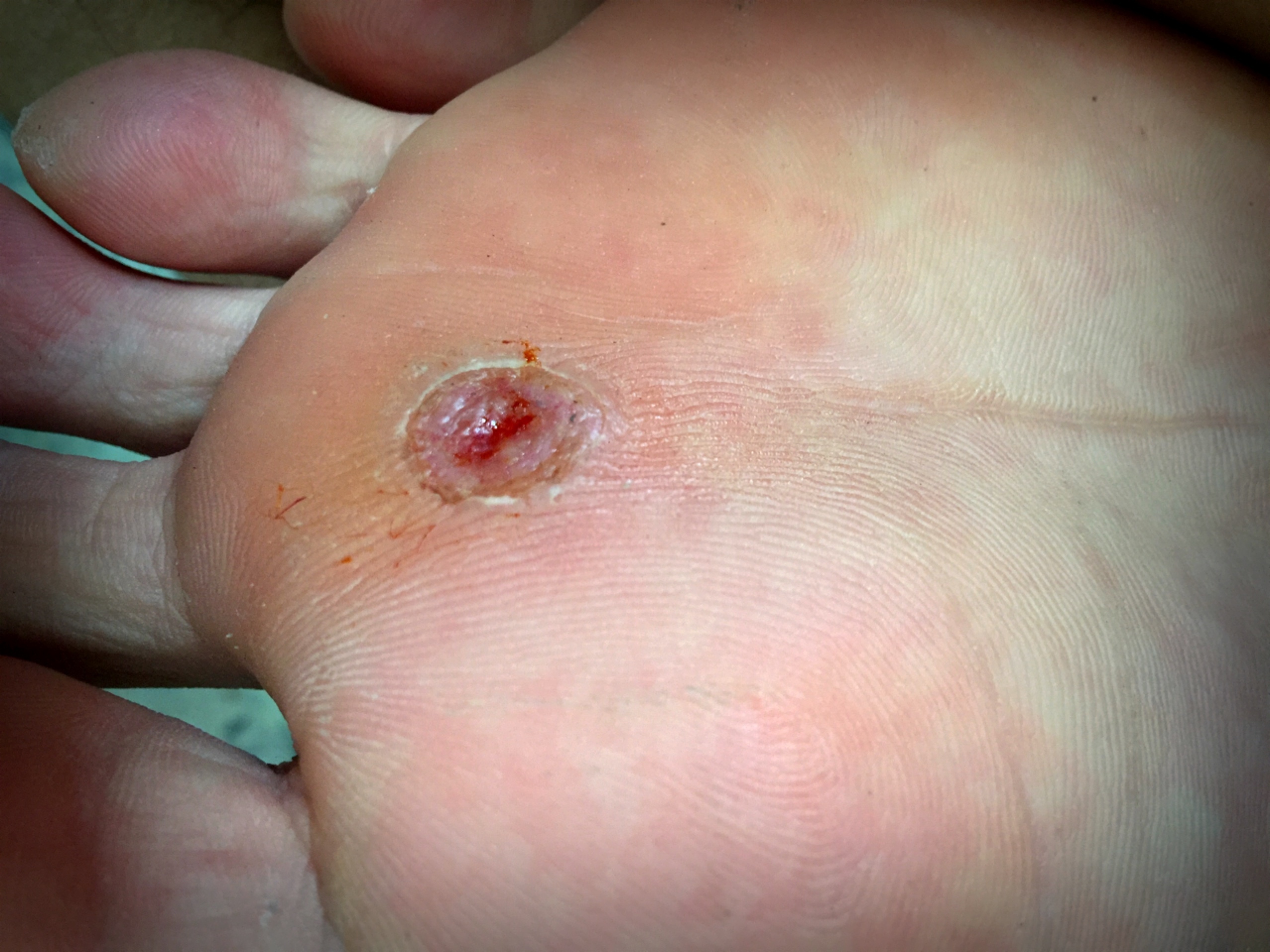 Ulcer-Foot