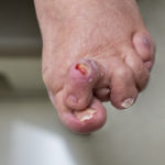 Wound Initial Visit