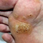 Removal of wart