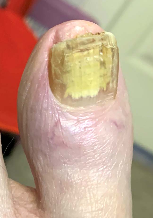 Patient education Nail and Skin yellow Toenails