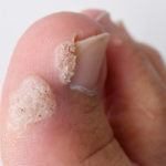 Removal of 14 or less warts