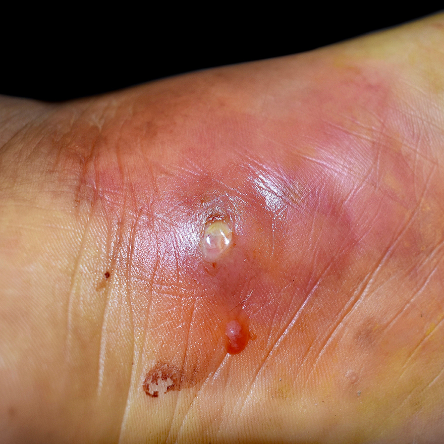 photos of staph infections