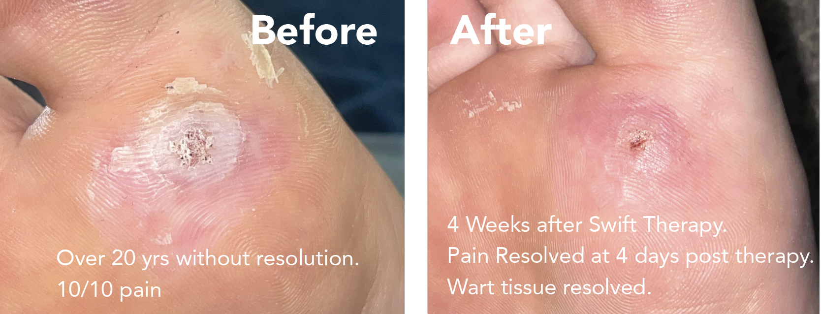 wart treatment before and after