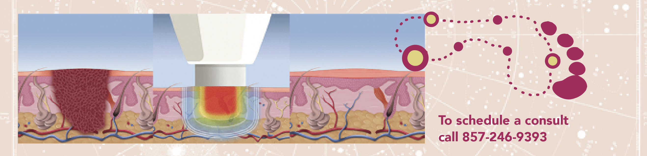 wart treatment consult with Nyota Medical Footsore