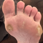 2-3 Callus/Corn Removal